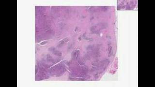 Histopathology Lymph nodeNodular sclerosis Hodgkin lymphom [upl. by Anelys739]