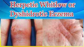 Herpetic Whitlow or Dyshidrotic Eczema [upl. by Ahon]