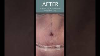 Tummy Tuck Before amp After Surgery  Plastic Surgeon Answers What is a Drainless Tummy Tuck shorts [upl. by Nwahsak117]