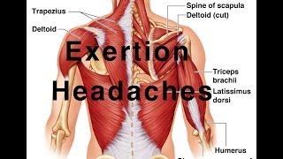 Tension amp Exertion headaches What are they How do you get them [upl. by Burgess]