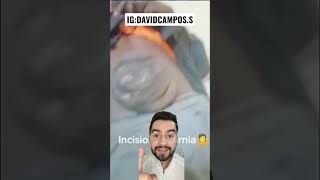 HERNIA INCISIONAL  HÉRNIA EN EL ABDOMEN [upl. by Sairtemed]