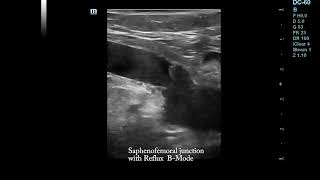 Saphenofemoral junction without and with reflux Duplex Ultrasound [upl. by Ainitsirc]