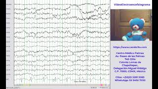 Demostración de un VideoElectroencefalograma [upl. by Eiramyllek]