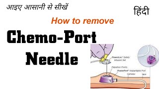 How to remove ChemoPort needle hindi  Chemoport  Dressing of chemoport  Removing port access [upl. by Nelyag]