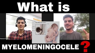 What is Myelomeningocele Watch Full Story of Patient  Ashishsharmavlogsofficial spinalcord [upl. by Monetta]