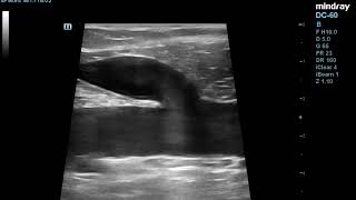 Ultrasound images of common femoral vein and saphenofemoral junction [upl. by Znarf912]