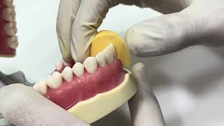 Anterior all ceramic crown preparation [upl. by Ragse]