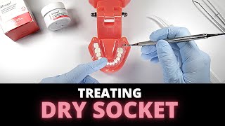 Tips For Managing Dry Socket Alveolar Osteitis  OnlineExodontiacom [upl. by Parthena210]