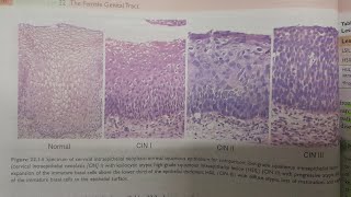 Cervical Intraepithelial Neoplasia  SPECIAL PATHOLOGY [upl. by Neggem325]