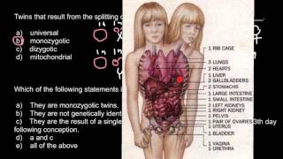 Definition of Monozygous Dizygous and Conjoined twins [upl. by Elo]