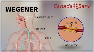 Wegener Granulomatosis [upl. by Achorn]