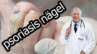 Psoriasis nägel [upl. by Berthoud]