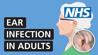 Ear infection in adults symptoms treatment and pain relief  NHS [upl. by Aniretake64]