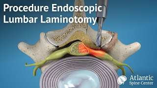 Procedure Endoscopic Lumbar Laminotomy [upl. by Pauline]