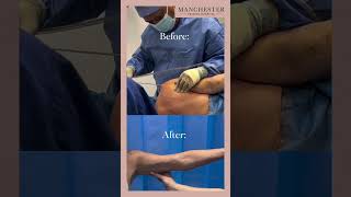 Debra’s Arm Vaser Liposuction Story 7Week Updates  Transformation to Slim PainFree Arms [upl. by Dana]