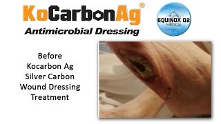 KoCarbon Ag Silver Wound Dressing  Case Study  Left Lateral Foot Ulcer Video [upl. by Proffitt]