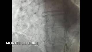 Dilatation stenting de la coronaire droite [upl. by Zeuqirdor]