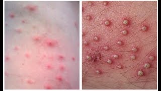 Home Remedies for Folliculitis  How to Get Rid of Folliculitis At Home [upl. by Bottali]