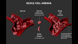 SICKLE CELL ANAEMIAsicklecellanemia anaemia medicinelectures medicaleducation [upl. by Ainesell]