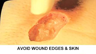 Enzymatic Debridement Demonstration Understand Wound Care [upl. by Leiso]