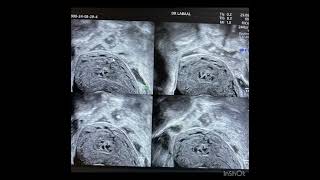 Malformation arterioveineuse uterineÉchographie [upl. by Edyaj]