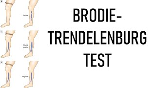 BrodieTrendelenburg Test examination of varicose veins [upl. by Parnell117]