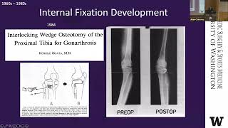 Osteotomy Past Present and Future [upl. by Atterahs615]