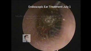 Ear wax removal CERUMEN cleaning 🧹 20230701 [upl. by Assennev]