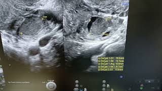 Endometrioma  Hemorrhagic Cyst  Ultrasound [upl. by Huckaby]