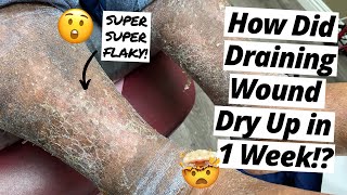 HOW Did This Draining Wound Dry Up In 1 Week SUPER FLAKY SKIN [upl. by Lucine]