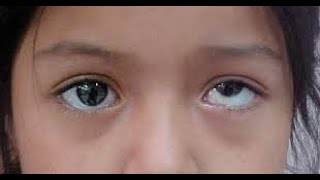 VERTICAL STRABISMUS  Introduction and Comitant Vertical Strabismus [upl. by Lime]