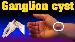 ganglion cyst [upl. by Elleved]