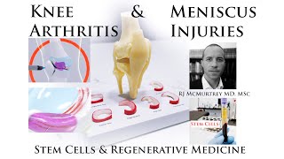 Regenerative Stem Cell Therapy for Knee Arthritis Cartilage Meniscus Tears Joints  Case Examples [upl. by Narik]