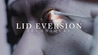 Ophthalmology Lid Eversion Techniques ubcmedicine [upl. by Hearn]