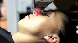 Laser Fraxel DUAL par le docteur thierry lafitte medecin esthetique paris [upl. by Yrrum]