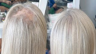 Vlight hair extensions alopecia  hair thinning hair extensions transformation [upl. by Naamana363]