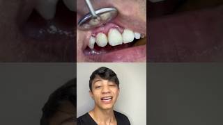 Sua Gengiva Sangra mesmo você tendo os dentes limposEntenda o TÁRTARO INVISÍVEL shorts [upl. by Denoting]