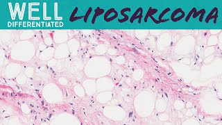 Well differentiated liposarcoma aka atypical lipomatous tumor pathology sarcoma soft tissue tumor [upl. by Musetta626]