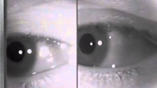 Physiologic EndGaze Nystagmus [upl. by Phillip3]