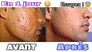 Comment supprimer LES BOUTONS DU VISAGE EN 1NUIT CA MARCHE VRAIMENT PROMIS🤫 [upl. by Nerval]