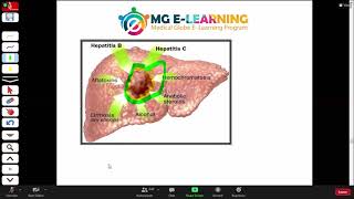 Hepatocellular carcinoma  Medicine  UrduHindi  Davidson [upl. by Ary]