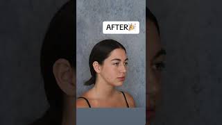 Chin Lipo BEFORE amp AFTER doublechin doublechinremoval chinlipo chinliposuction plasticsurgery [upl. by Stoddart]