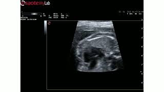 Ultrasound video of Membranous VSD and overriding aorta [upl. by Juliet612]