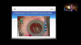 Lecture Hydrodissection [upl. by Etrem]