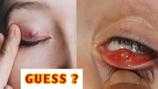 Stye or chalazion  explained indetail eyecareoptom eyelid infection lidproblems [upl. by Ilil51]