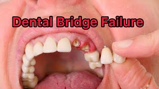 Don’t Get A Dental Bridge Wirhout Watching This [upl. by Annabela]