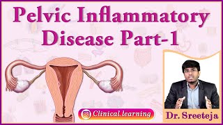 24 Pelvic Inflammatory Disease  Part 1 [upl. by Porcia721]