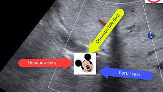 Hepatobiliary ultrasound Two cases [upl. by Leinadnhoj]