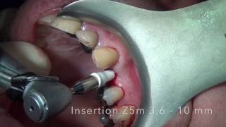 Implant Ceramique Zircone Z5m [upl. by Ytissahc159]