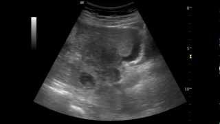 Ruptured Ectopic Pregnancy  QMH AED Ultrasound Casebook 201208 Video 1 [upl. by Bander731]